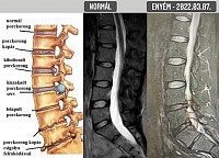 Gerincsérv, Spartan, Porckorongkopás, VTSE
